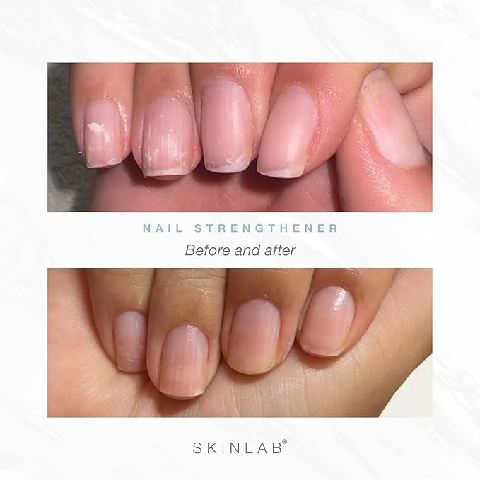 Skinlab’s Premium Nail Strengthening Serum – Boosts Nail Growth & Resilience – Stronger, Healthier, Longer Nails – 3 Month Supply – Dermatologist Tested – Hypoallergenic – Cruelty-Free & Paraben-Free