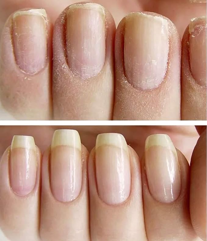NAILVIVE Nail Serum Powerful Magic-like Silk Proteins Proven Natural Formula Strengthening Hardening nails Instantly Prevents Splits Chips Peels Cracks on Your Nails (PEN APPLICATOR)