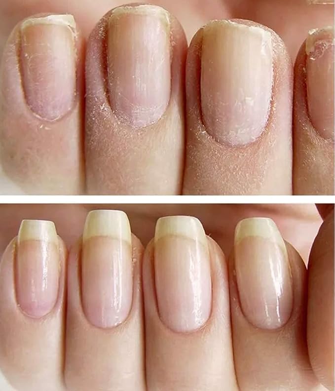 NAILVIVE Nail Serum Powerful Natural Keratin Nail Treatment Silk Proteins Proven Natural Formula Strengthening Hardening nails Instantly Prevents Splits Chips Peels Cracks on Your Nails (Bonus Pack!)