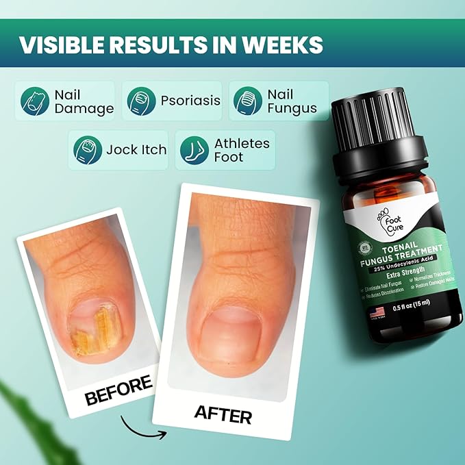 FOOT CURE Toenail Fungus Treatment for Fingernails, Nail repair, Toenail Softener, Yellow Toenail Treatment, Ingrown Nails and Foot Fungus Treatment Extra Strength (Pack of 1)