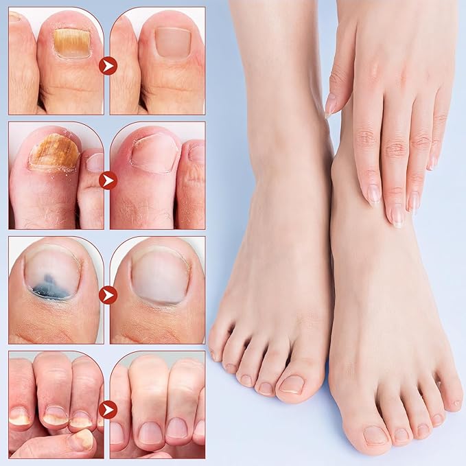 Toenail Repair Extra Strength,Nail Patches 21 PCS, Overnight Nail Fast Acting Repair Effortless Hydrogel Nail Care for Men and Women