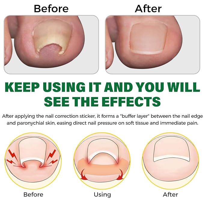 Ingrown Toenail Treatment,100 Pcs Breathable Ingrown Toenail Strips-Toenail Lifter and Small Scissors, Painless Ingrown Toenail Tool, Professional Pedicure for Ingrown Toenail, Toenail Corrector Patch