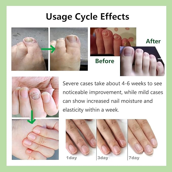 Natural Nail Care Gel, Nutraboost Strengthening Cuticle Serum for Damaged & Brittle Nails, 20ml (1 pcs) (2pcs)