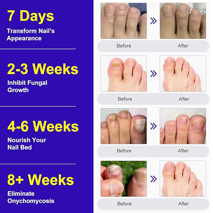 Toenail Fungus Treatment Extra Strength, 24 Pcs Fungal Nail Patches for Toenail Fungus Treatment Overnight, Nail Repair for Damaged Nails, Toenails Care Supplies, Restore Discoloration and Thickness