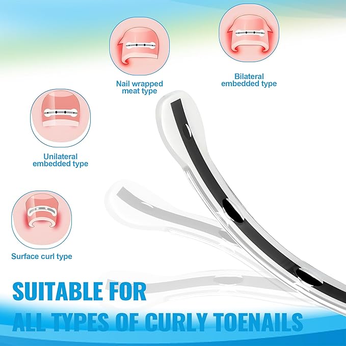 10 Pcs- Ingrown Toenail Treatment Kit with Nickel-Titanium Memory Wire, Professional At-Home Ingrown Toenail Removal kit for All Size Curve Correct, Ingrown Toenail Tools for Quick Relief.