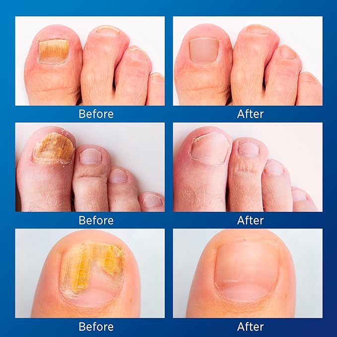 Toenail Fungus Treatment Extra Strength: (Small) 32 Patches with Hydrogel for Overnight Repair Fungus Nail Treatment For Toenail - Nighttime Nail Patches Visible Results in 8 Hours