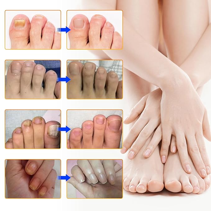 32 PCS Fungal Nail Patches for Broken Damaged Split Nails,Toenail Treatment Extra Strength,Nail Repair for Damaged Nails, Nails Care Supplies, Restore Discoloration and Thickness (2 Pack)