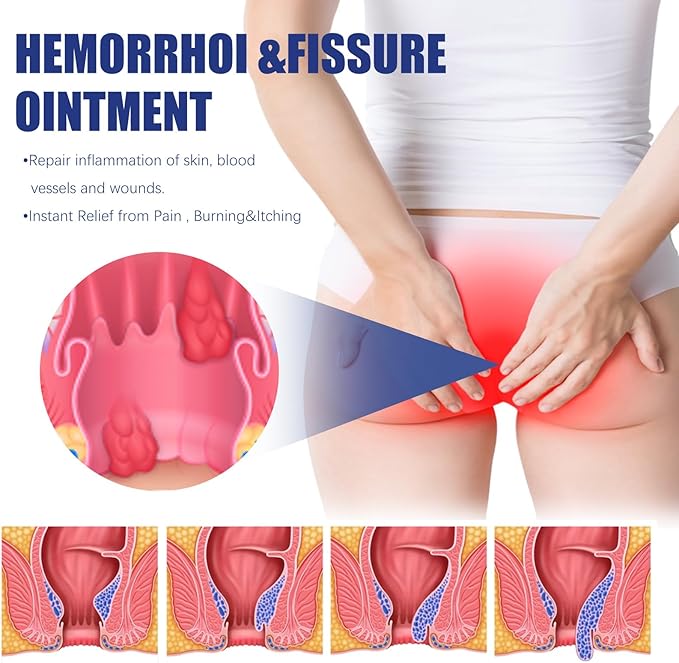 Herbal Hemorrhoid Cream, Professional Hemorrhoid Treatment Cream,Quickly take Effect to Relieve discomfort (2)