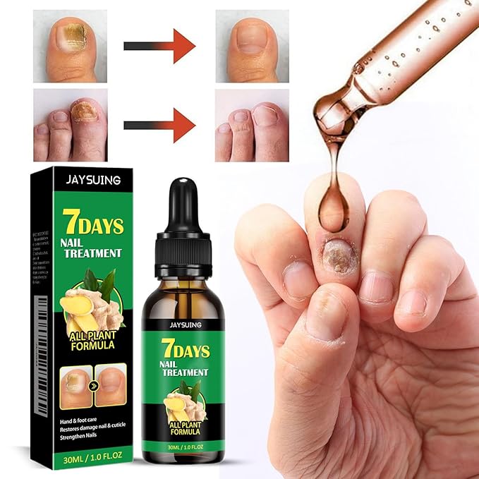 3Pcs Ginger Nail Treatment, 7days Nail Growth Serum Solution, Ginger Cuticle Care Oil for Nails Strengthener, Promote Nail Healthy Grow(30ml)