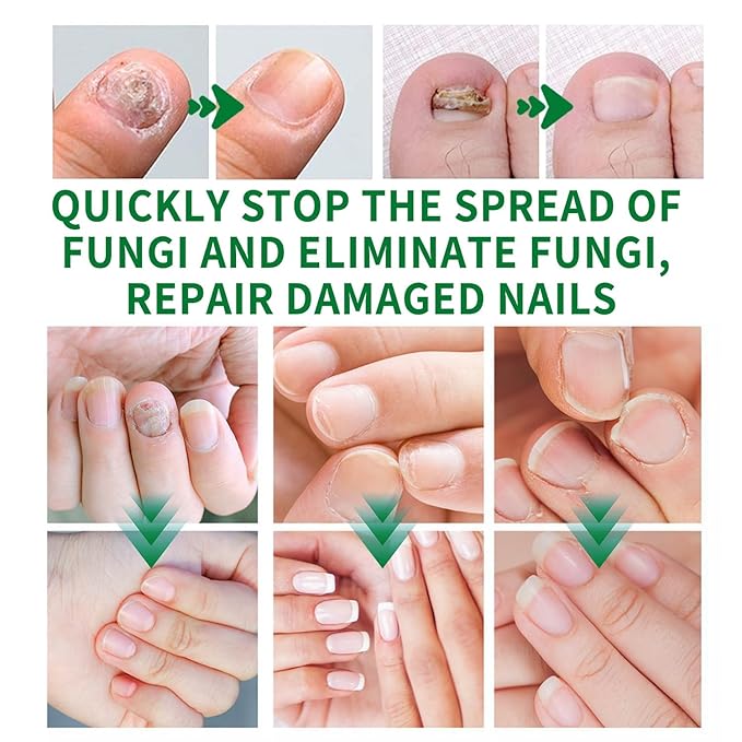 3Pcs Ginger Nail Treatment, 7days Nail Growth Serum Solution, Ginger Cuticle Care Oil for Nails Strengthener, Promote Nail Healthy Grow(30ml)