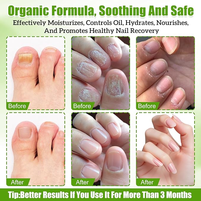 Orvalle Nail Fungus Pen,Nail Growth Treatment Repair Serumtwist Pen for Repair & Strengthener，Fungus Pen for Toenails and Fingernails (3PCS)