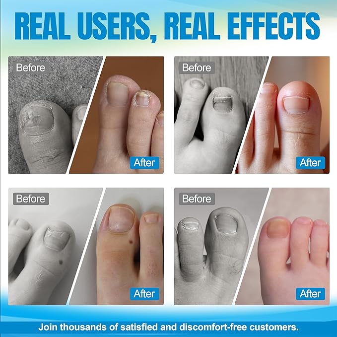 10 Pcs- Ingrown Toenail Treatment Kit with Nickel-Titanium Memory Wire, Professional At-Home Ingrown Toenail Removal kit for All Size Curve Correct, Ingrown Toenail Tools for Quick Relief.