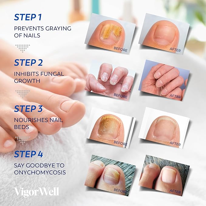 Toenail Fungus Treatment Extra Strength - (Medium) 32 Nighttime Hydrogel Patches for Overnight Toenail Repair - Visible Results in 8 Hours - Fungal Nail Patches for Toenail Fungus Relief