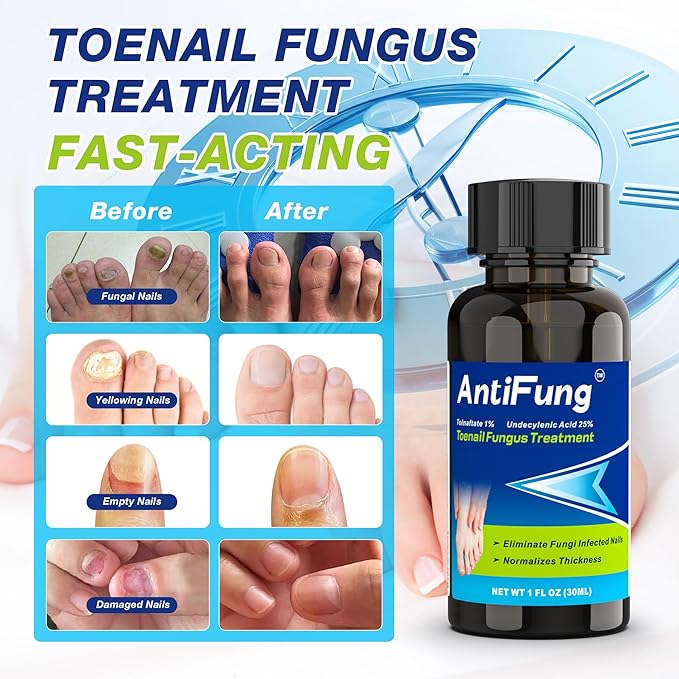 Toenail Fungus Treatment Extra Strength – Nail Repair for Damaged Nails, Thick, Yellow, and Discolored Toenails – Fast Acting Formula for Fungus Relief with Tea Tree Oil, 30ml / 1oz